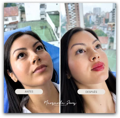 Resultado de tratamiento facial